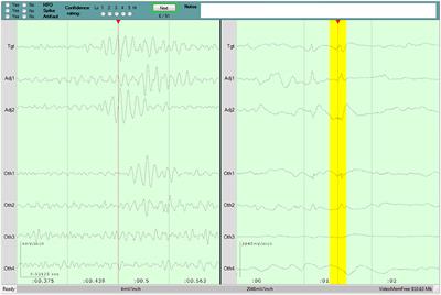 Generalizability of High Frequency Oscillation Evaluations in the Ripple Band